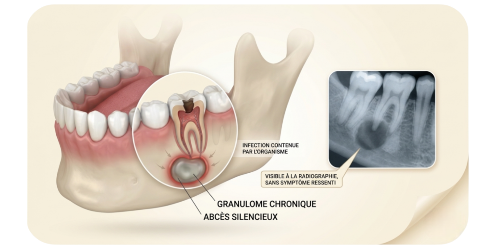 Granulome chronique - abcès dentaire