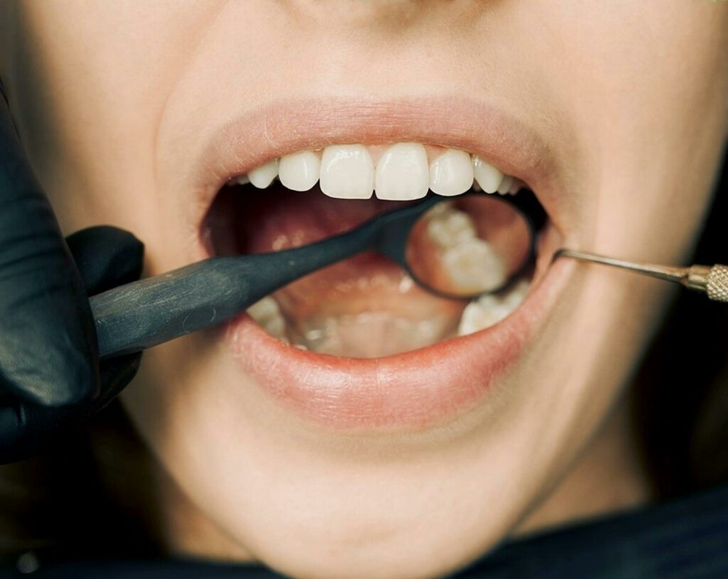 entretien dentaire - ares dental