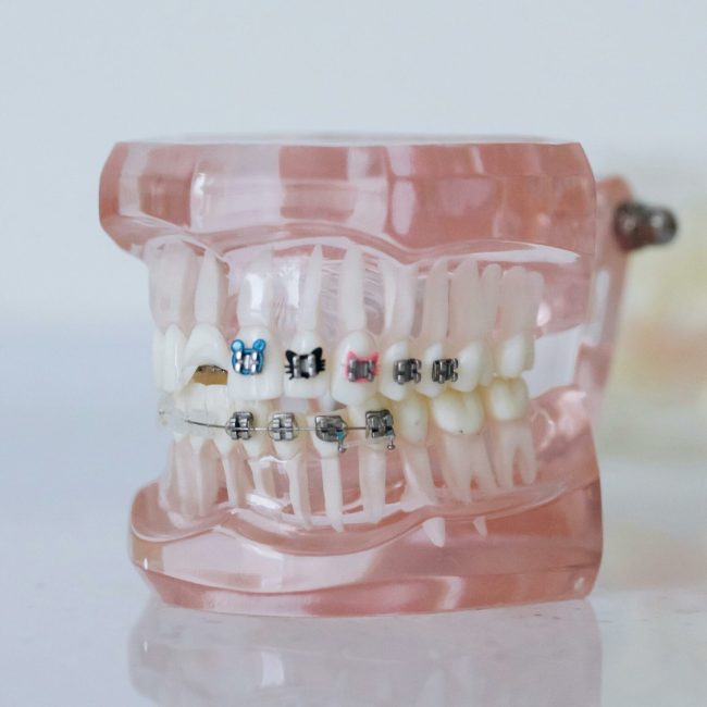 appareils dentaire fixe enfant pexel