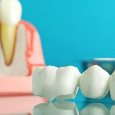 couronne dentaire Ares Dental
