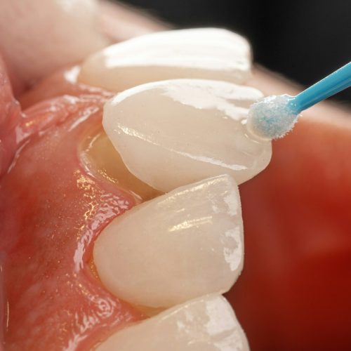 facettes dentaires ares dental