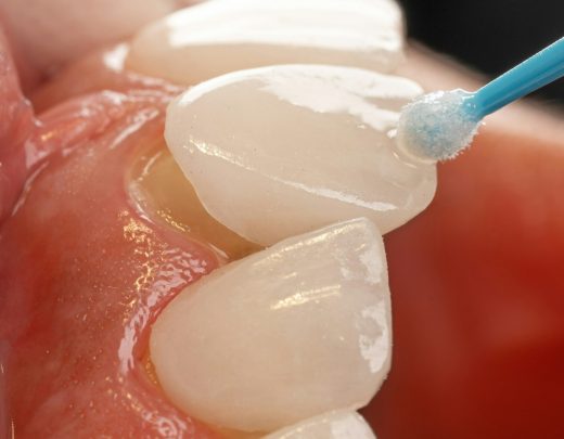 facettes dentaires ares dental