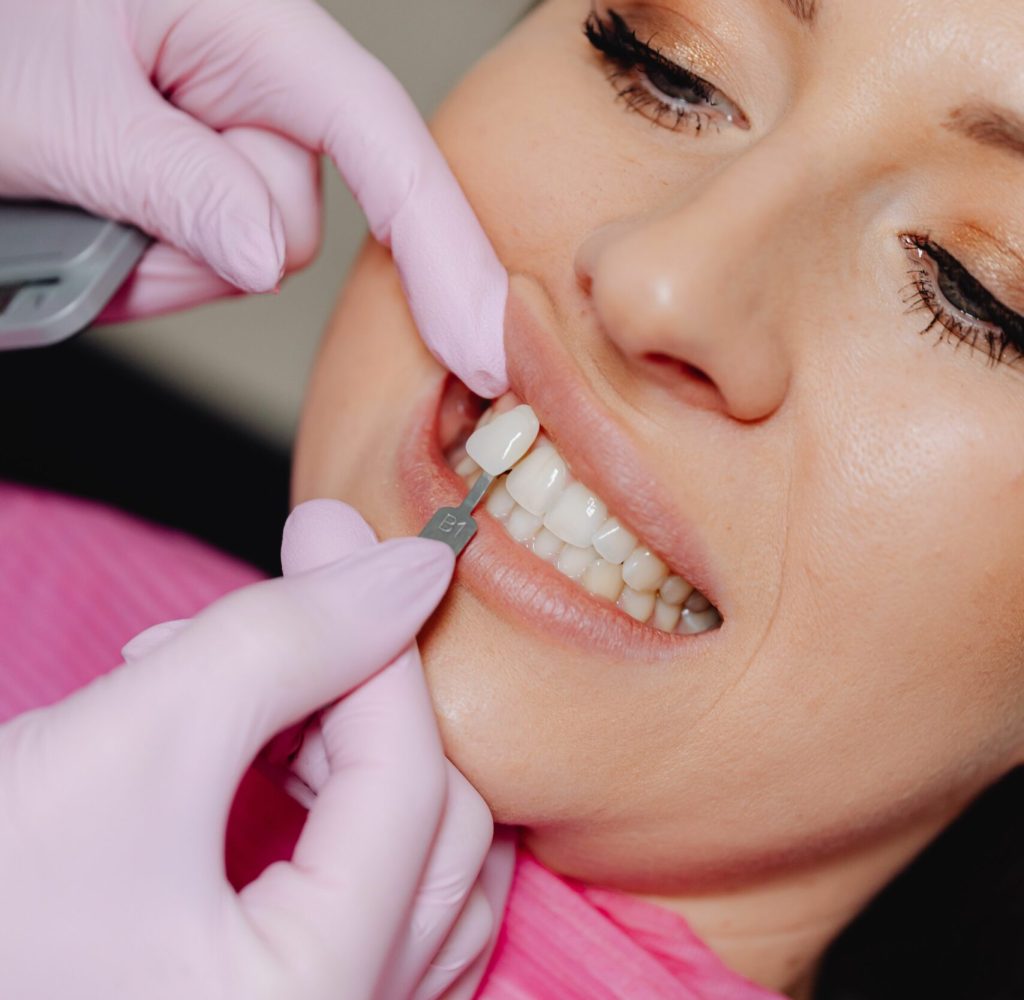 pose de facette dentaires - Ares Dental 2