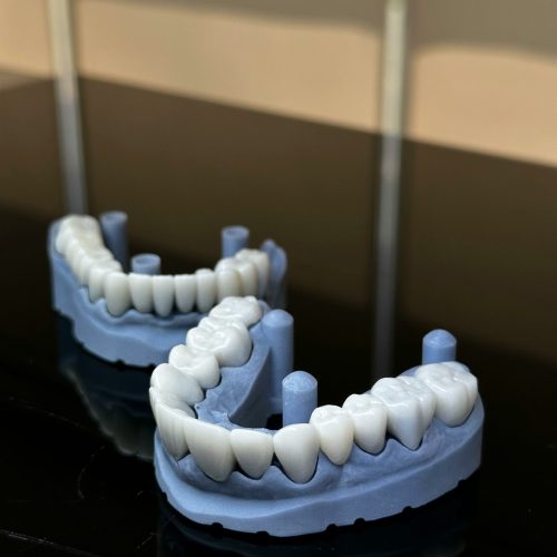 deux prothèses dentaires cote a cote - ares dental